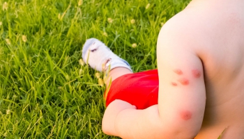 Kukaiņu kodumi: kā mazināt diskomforta sajūtu un alerģiskas reakcijas bērniem