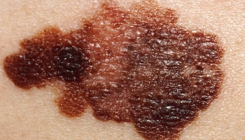 Диагностика кожных заболеваний: тандем РТУ и ЛУ открывает новые возможности